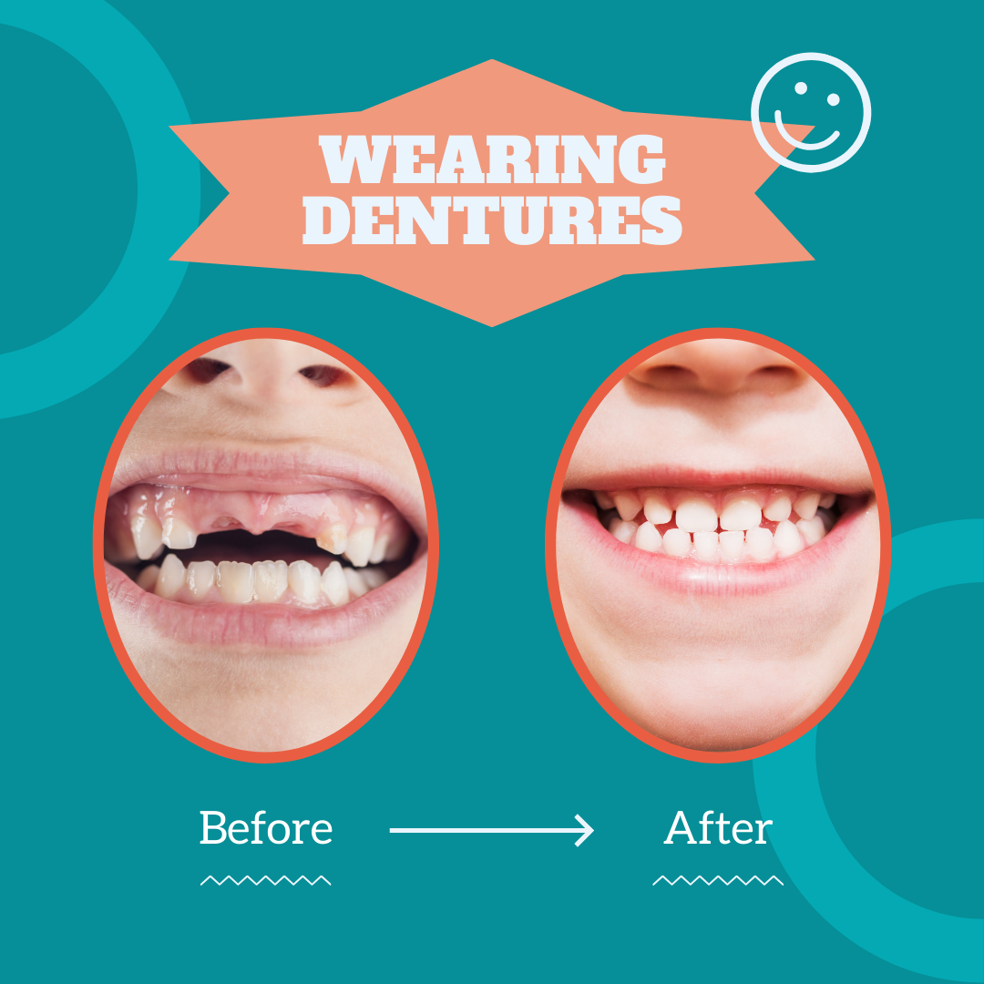 Two photos showing a mouth with missing teeth before dentures, and a second mouth with teeth after dentures.