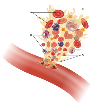 This figure shows an artery with a small puncture at its center. Blood is gushing out of the puncture, carrying with it the four major blood components, which are labeled A through D. Component A indicates the red, disk-shaped cells with a depression at their center. Component B indicates the white-colored cells with purple, bean-shaped nuclei. Component C is the yellowish liquid component of the blood. Component D indicates small, yellow, star-shaped bodies within the fluid.